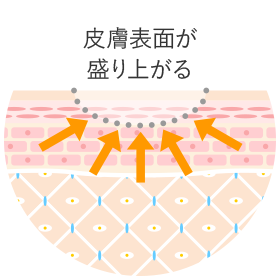 数週から数か月後で内側から皮膚が盛り上がる